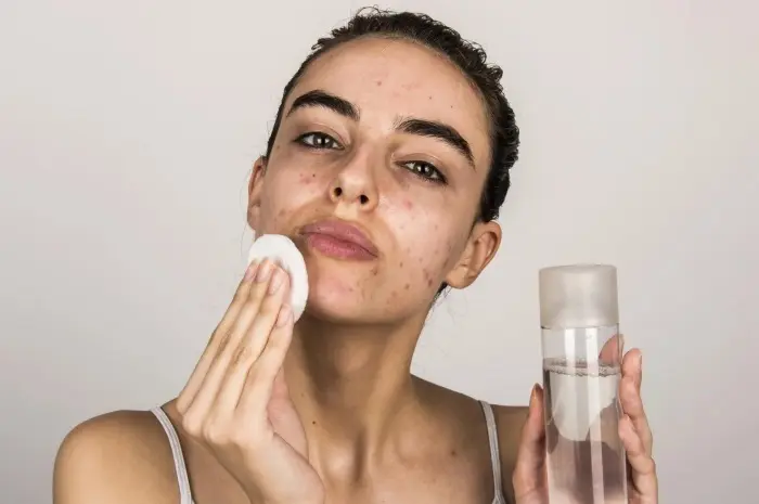 9 Skincare Recommendations for Acne-Prone Skin