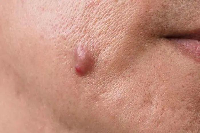 10 Effective Tips to Remove Cystic Acne on the Nose Safely and Quickly